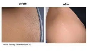 before and after laser hair removal treatment in boca raton