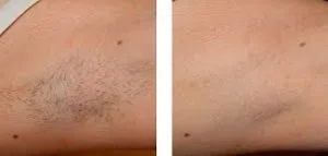 Laser Hair Removal