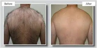 before and after laser hair removal treatment in boca raton