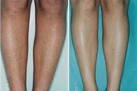 before and after laser hair removal treatment in boca raton