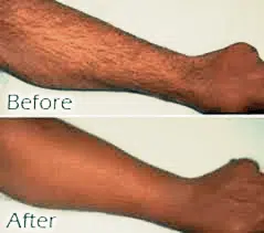 before and after laser hair removal treatment in boca raton