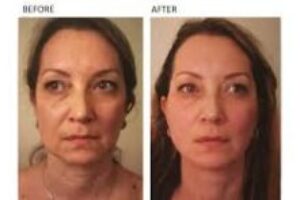 PDO Threads Facelift PDO Threads Facelift