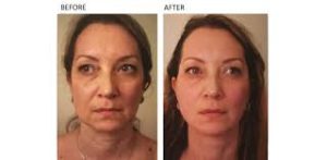 PDO Threads Facelift PDO Threads Facelift