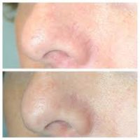 before and after treatment before and after medical beauty treatment in boca raton