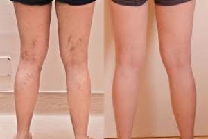 before and after treatment before and after medical beauty treatment in boca raton