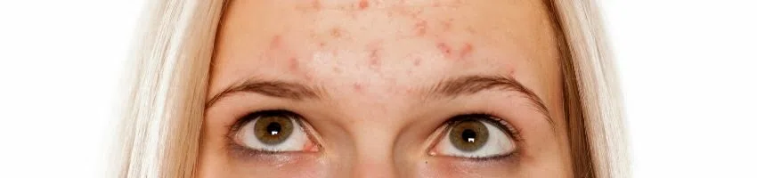 acne breakouts caused by almond milk acne breakouts caused by almond milk