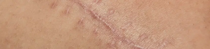 A picture of breast scar