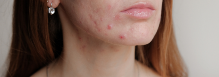 A picture of a 30's woman experiencing acne outbreak