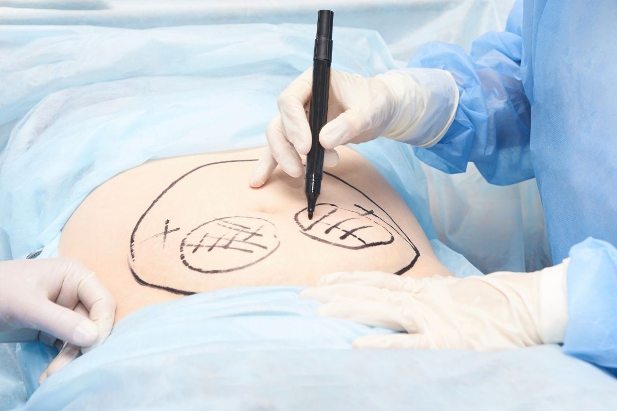 Someone going through a stomach liposuction treatment.