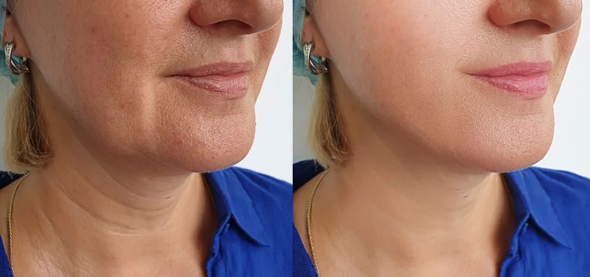 artefill is it effective or just a waste of money (1) A picture of a woman before and after undergoing an artefill.