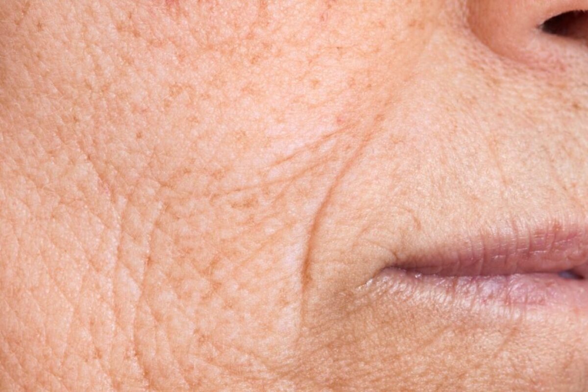 artefill is it effective or just a waste of money (3) The woman has many wrinkles on her face.