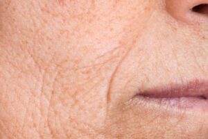 The woman has many wrinkles on her face.