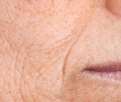 The woman has many wrinkles on her face.