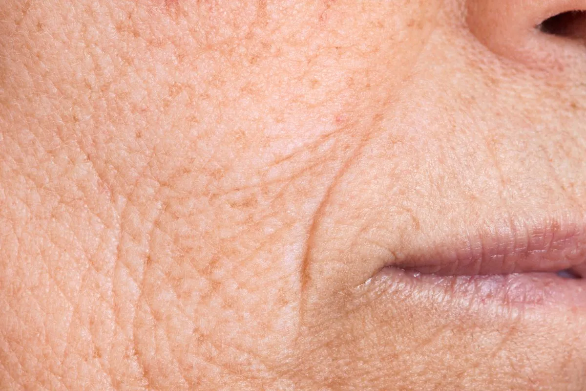 The woman has many wrinkles on her face.