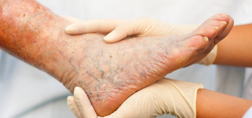 Someone massaging the foot of a person suffering from varicose veins.