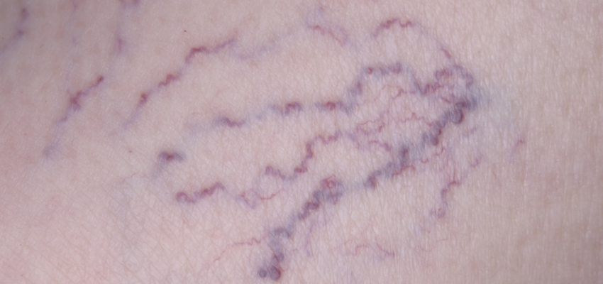 A close-up shot of spider veins on the face caused by blood not flowing correctly, either because of a defective vein or because your blood flow is irregular.