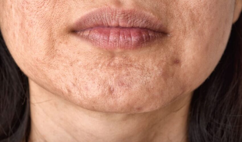 A woman wonders if exfoliation will help her acne scars.