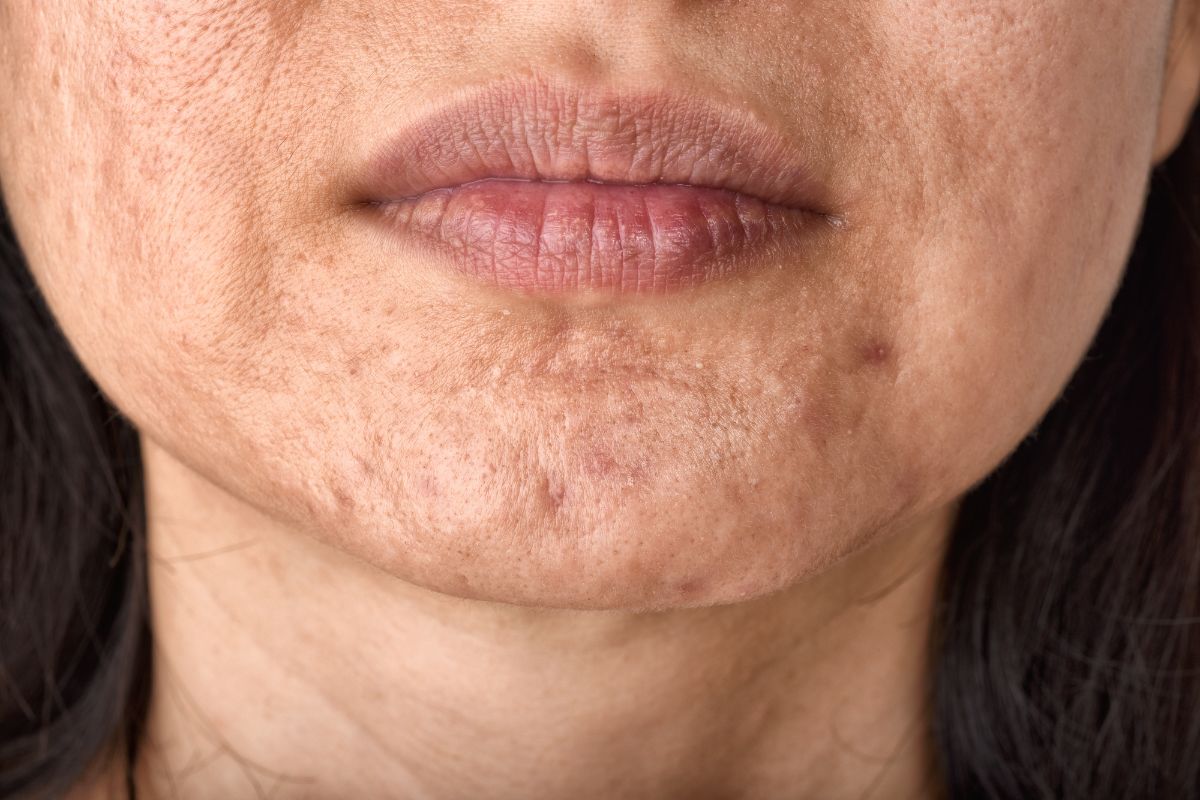 A woman wonders if exfoliation will help her acne scars.