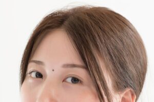 A woman was born with monolids and decided to have double eyelid surgery.