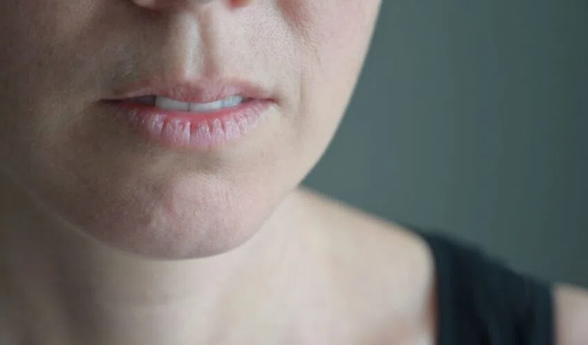 The woman has vertical lip lines, one of the aging indicators.