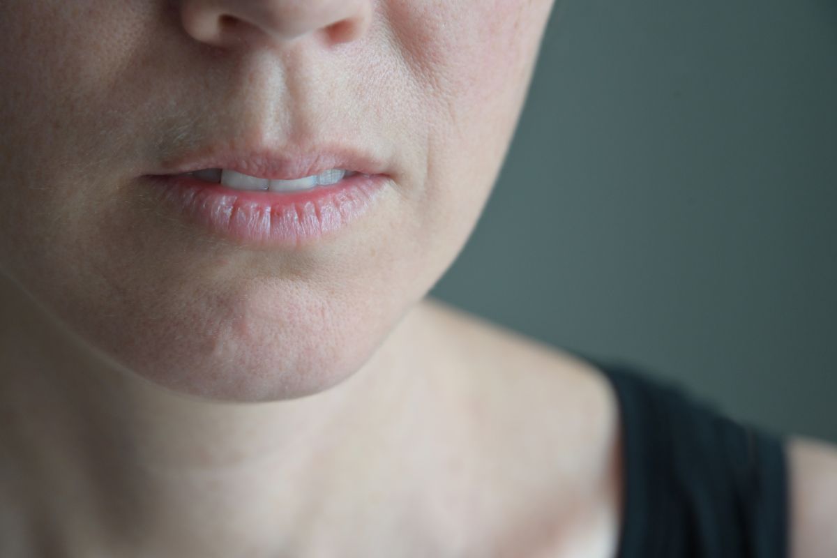 The woman has vertical lip lines, one of the aging indicators.