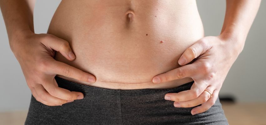 A woman's tummy looks firmer and tighter after body lift surgery.