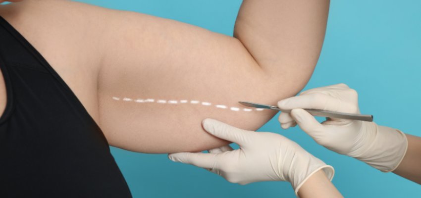 The woman decides to undergo liposuction on her arm.