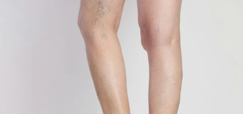 A person's legs have varicose veins.