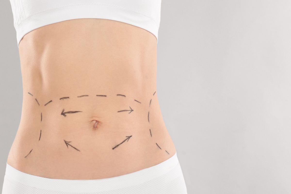 The person who wants to undergo skin removal surgery to remove excess skin due to weight loss.