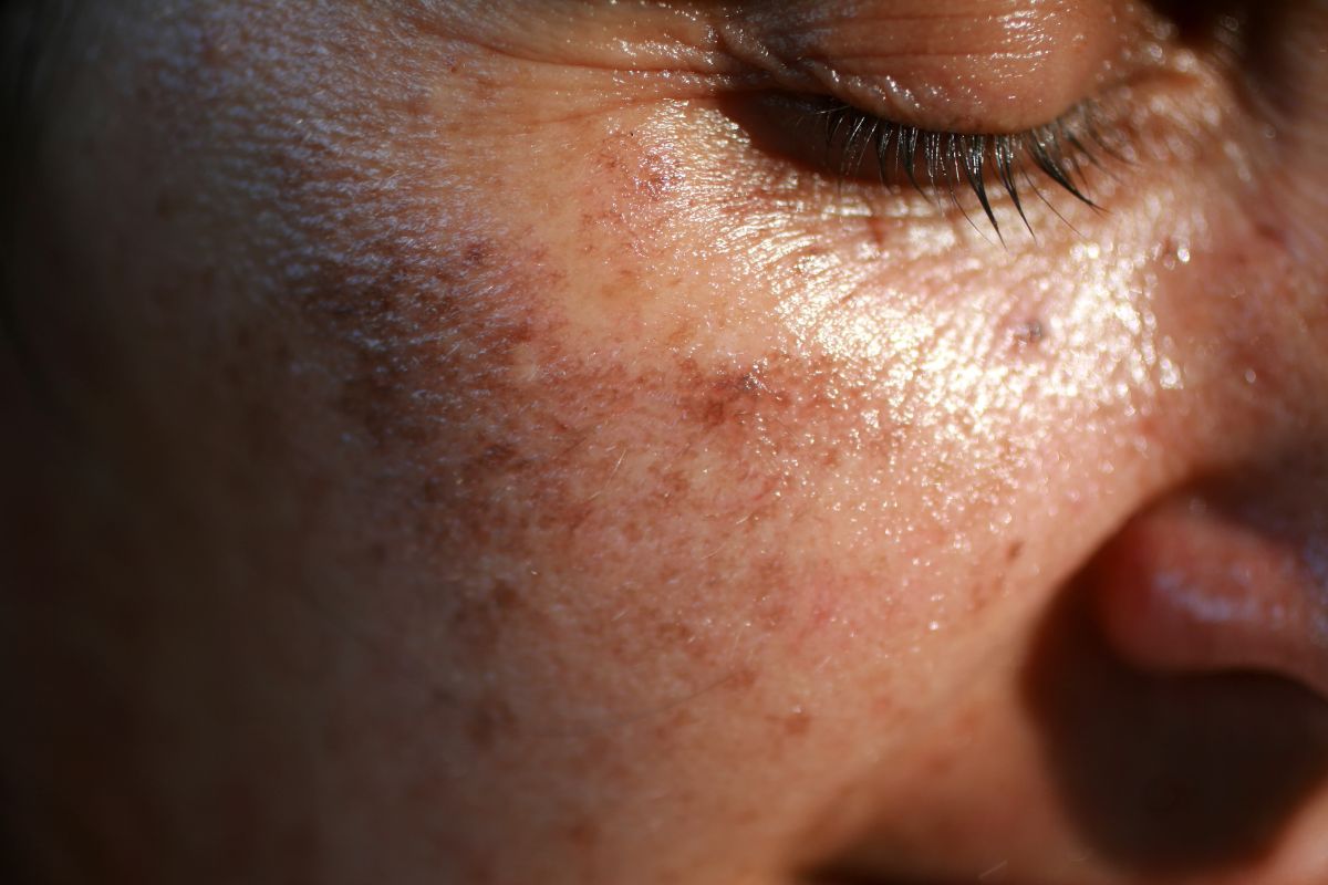 The woman has age spots on her cheeks.