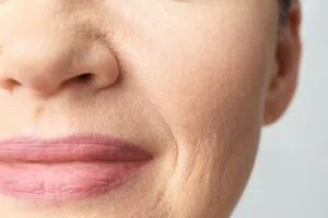 The woman has lip wrinkles.