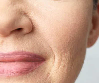 The woman has lip wrinkles.