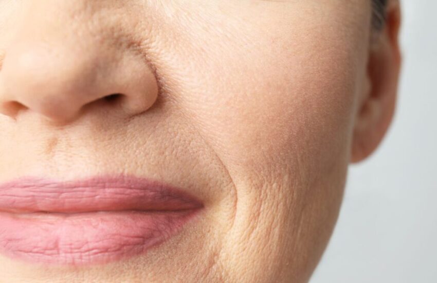 The woman has lip wrinkles.