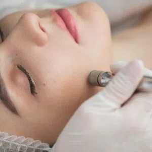 Microdermabrasion in Boca Raton