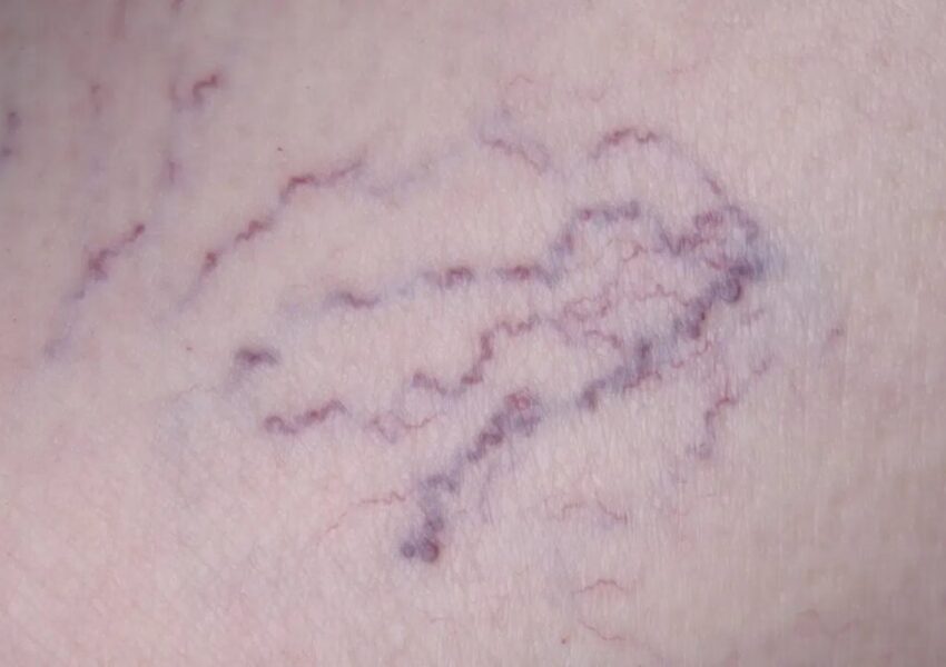 A close-up shot of spider veins on the face caused by blood not flowing correctly, either because of a defective vein or because your blood flow is irregular.