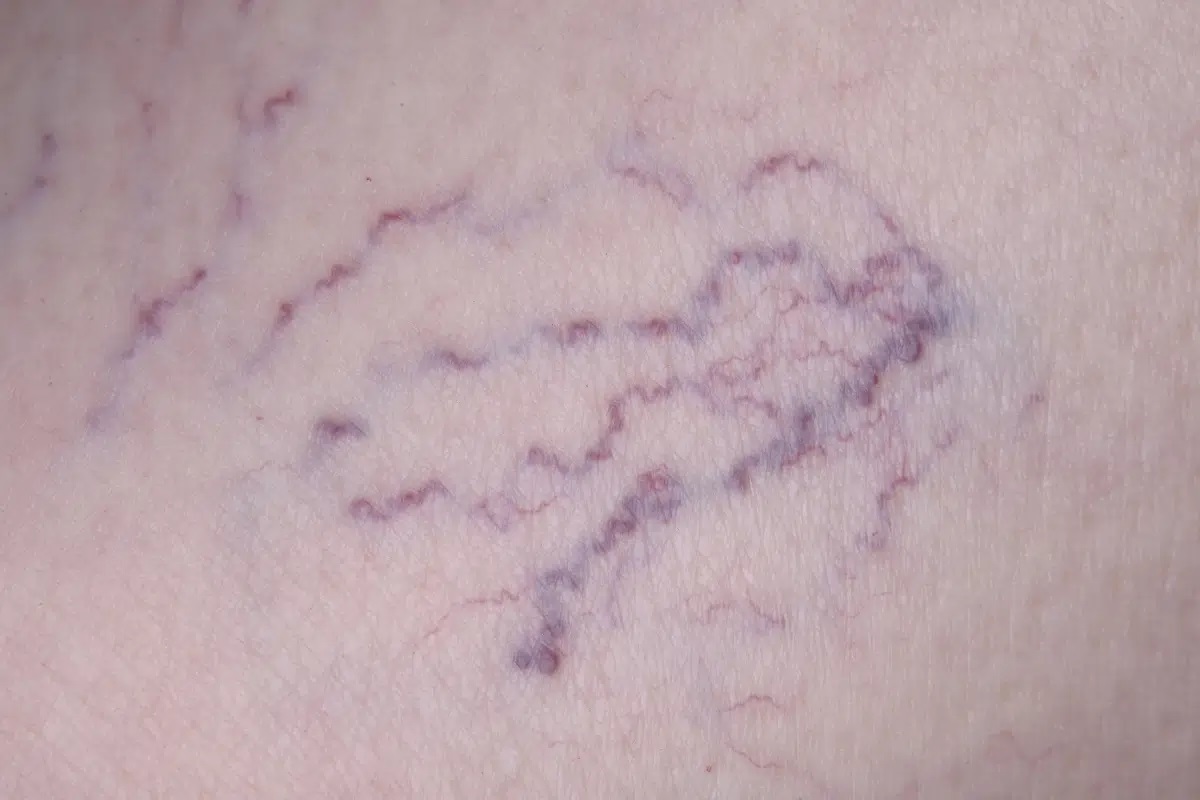 A close-up shot of spider veins on the face caused by blood not flowing correctly, either because of a defective vein or because your blood flow is irregular.