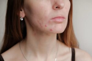 A picture of a 30's woman experiencing acne outbreak