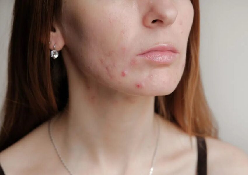 A picture of a 30's woman experiencing acne outbreak