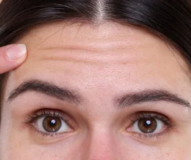 The woman has forehead wrinkles.