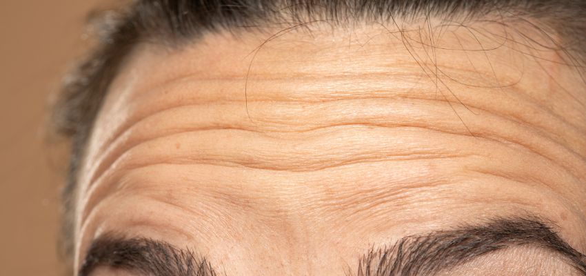 how to remove forehead wrinkles (2) A forehead wrinkles.