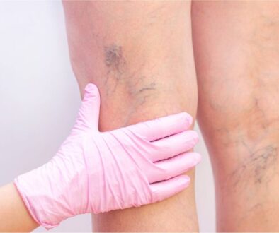 The doctor examines the spider veins on the patient's legs.
