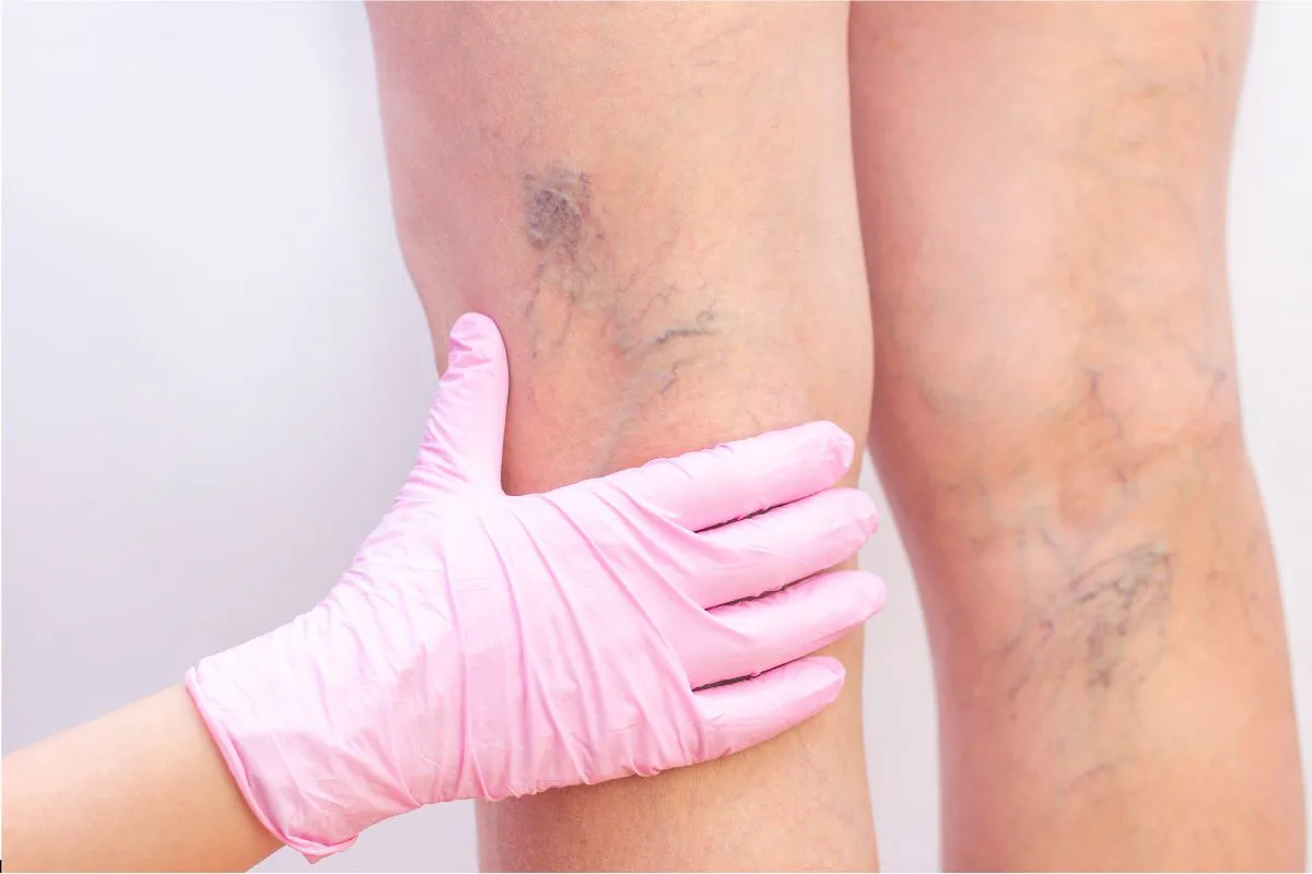 how to get rid of spider veins naturally (3) The doctor examines the spider veins on the patient's legs.