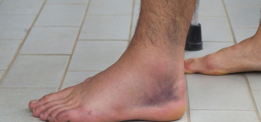why are my ankles dark (2) The woman has dark ankles due to poor blood circulation in her veins.