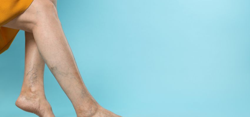 The woman has blue spider veins.