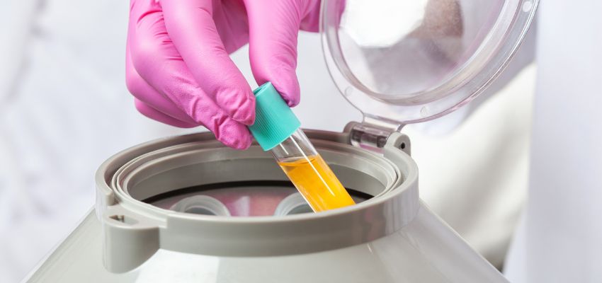platelet-rich-fibrin1 Laboratory preparation of platelet rich fibrin with a test tube placed in a centrifuge.
